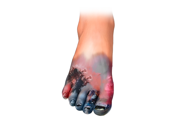 Gangrene Treatment In Hyderabad